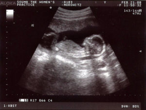 semana 15 embarazo gemelar