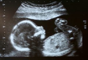 semana 26 embarazo gemelar