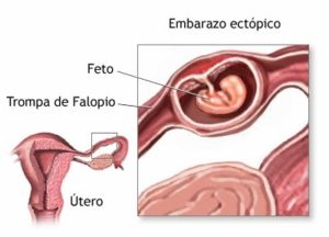 embarazo ectopico abdominal